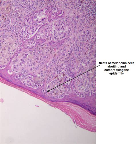 Dermpath Made Simple Neoplastic Melanoma Superficial Spreading And