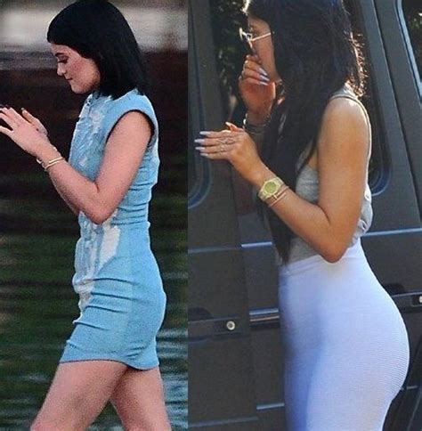 Before and After pictures - Kylie Jenner plastic surgery ...