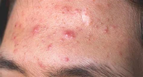 Ingrown Hair Or Std Pimple Wart Staph Spider Bite Skin Cancer