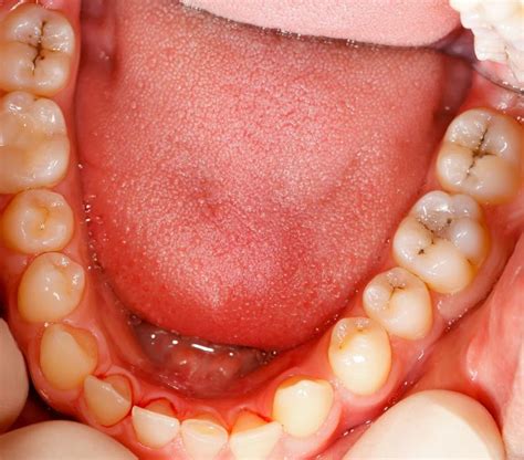 Signs Of Cavities Near 55116 Faq Dentist In Saint Paul Mn