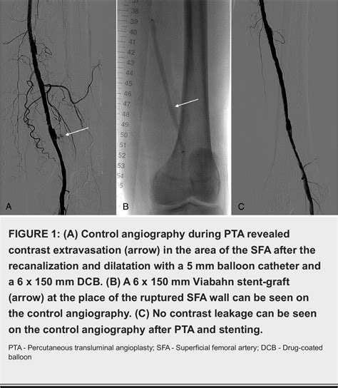 Figure 1 From Superficial Femoral Artery Pseudoaneurysm And Arterial