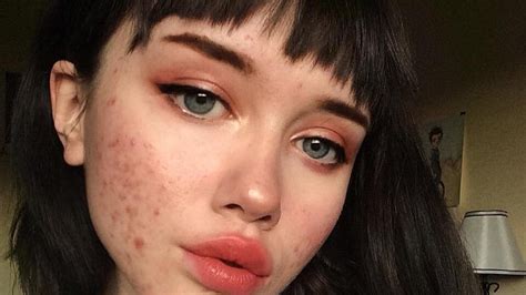 Faces of facebook (facebook'un yüzleri). Teen Shares Viral Acne Message on Instagram | Teen Vogue