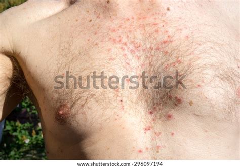 Chest Skin Rash Drug Side Effect Stock Photo Edit Now 296097194