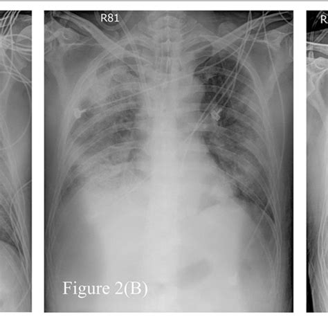Serial Chest Radiographs Of The Patient A The Film Showing Diffuse