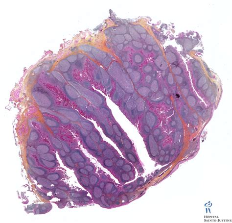 Nodal Lymphoid Follicle Human Pathology