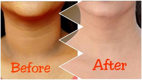 How To Get Rid Of Dark Neck In 15 Minutes Fast And Qu Doovi