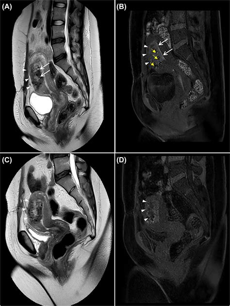 multimodal postpartum imaging of a severe case of couvelaire uterus