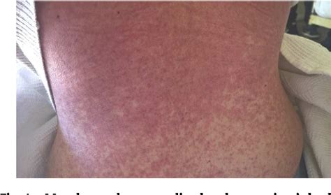 Figure 1 From Infectious Mononucleosis Skin Rash Without Previous