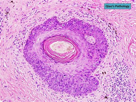 Qiao S Pathology High Grade Squamous Intraepithelial Lesion Of The
