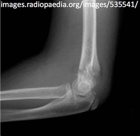 Interpreting Elbow And Forearm Radiographs — Taming The Sru