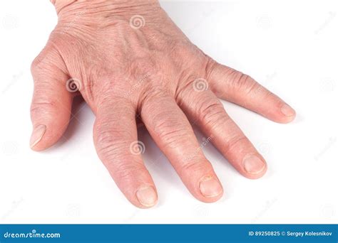 Rheumatoid Polyarthritis Of Hands Isolated On White Background Stock