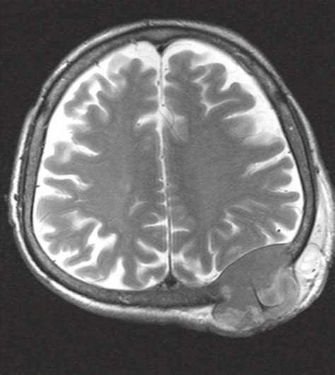 Brain Mri With A Subcutaneous Metastasis From Hepatocellular Carcinoma