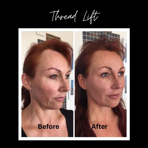 Pdo Threading Kent Non Surgical Facelift London Private Thread Lift Uk