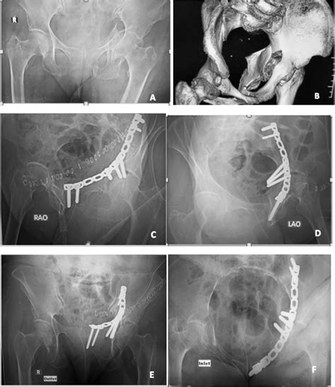 Fixation Of Quadrilateral Plate Fractures Of The Acetabulum Using The