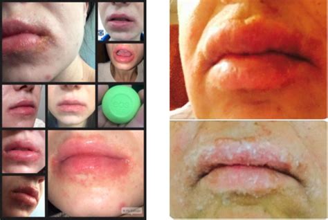 Women Say They Have Blisters And Rashes After Using Eos Lip Balm