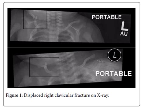 clinical-pediatrics-fracture