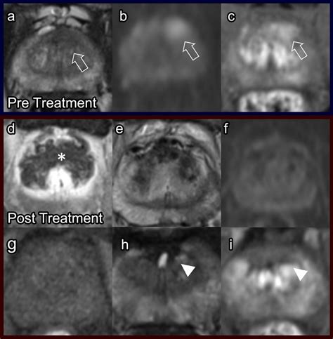 Irreversible Electroporation Pre Treatment Prostate Mri Axial T2 A