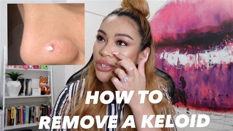 How I Removed My Nose Piercing Bump Keloid Fast Youtube