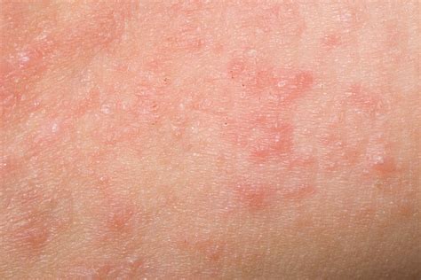 Identifying Skin Rashes In Adults