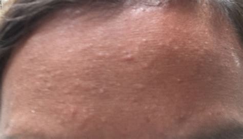 Small Bumps On Forehead General Acne Discussion By Sam Acne