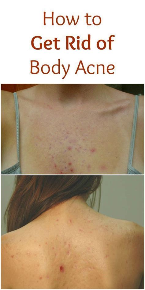 If You Want To Get Rid Of Your Body Acne In The Long Term You Will