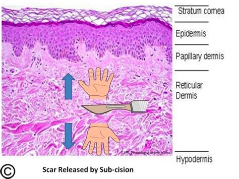 Rolling Scar Rewind Treatment Subcision And Filler Procedure