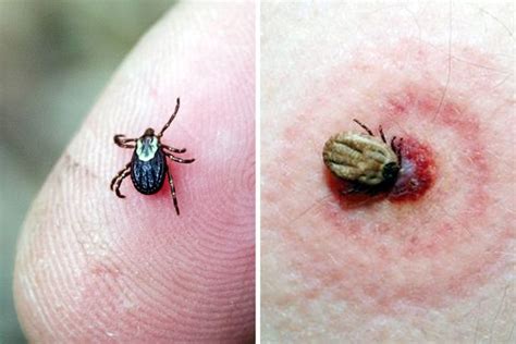 Insect Bites Guide Pictures And Treatment Advice For Bites And Stings