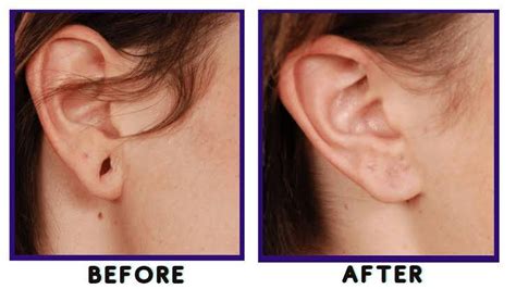 What Is Ear Reconstruction Surgery