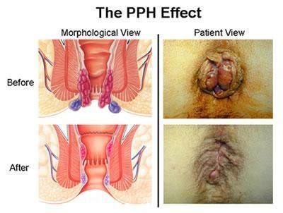 External Hemorrhoids Before And After
