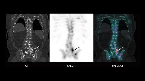 Spectct Imaging In The Evaluation Of Pain Following Spinal Fusion