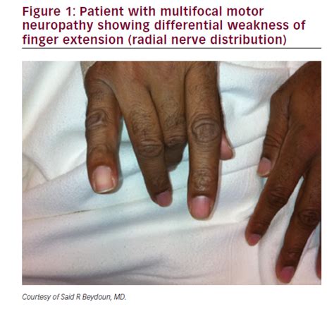 Differentiating Multifocal Motor Neuropathy From Entrapment Neuropathy