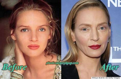 Uma Thurman Plastic Surgery Before And After Pictures Uma Thurman