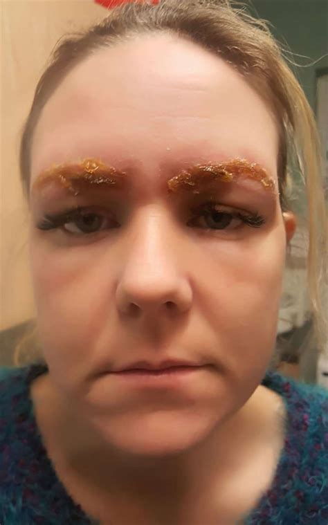 Newmarket Woman Issues Warning After Severe Allergic Reaction To