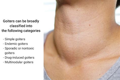 Goiter Causes Symptoms Types Diagnosis And Home Remedies