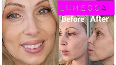 Lumecca Ipl Before And After North Shore Laser Clinic Youtube