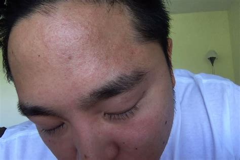 Redflesh Colored Bumps On Forehead Side Of Face And Cheeks At A