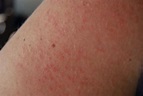 Prickly Heat Rash Pictures