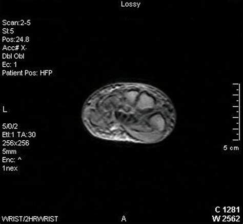 Multiple Cysts In Carpal Bones Eurorad