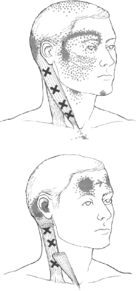 Figure 1 From Cervicogenic Headache Caused By Myofascial Trigger Points