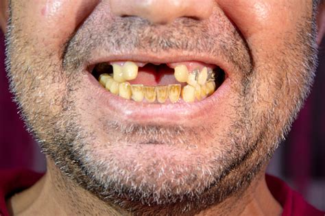 Toothless Man Smiling Man With Yellowed Teeth Stock Photo Download