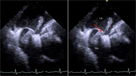 Caught In The Act Thrombus Straddling A Patent Foramen Ovale