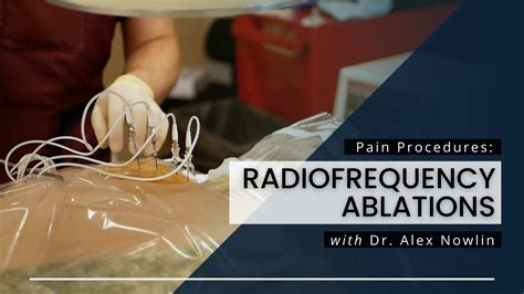 Radiofrequency Ablations What You Should Know Youtube
