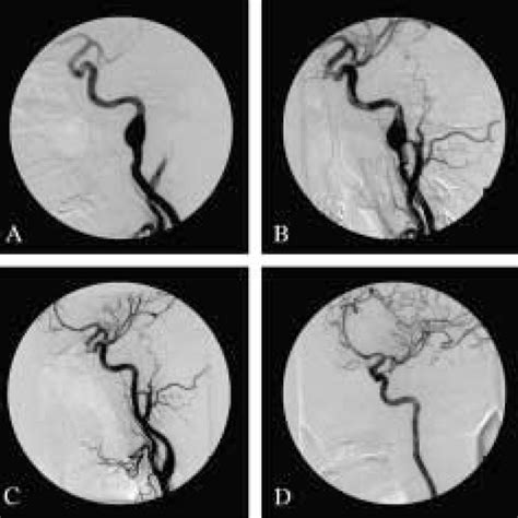 Angiographic Studies In A 37 Year Old Woman With Headaches Who Had