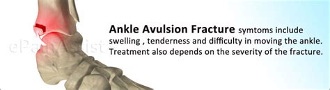 Ankle Avulsion Fracturesymptomscausestreatmentrecovery Timeexercises