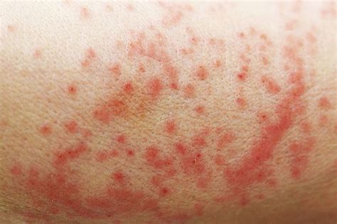 Why Do My Armpits Itch Common Causes And Treatments Of Itchy Armpits