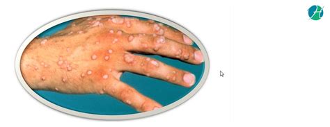 Human Papillomavirus Symptoms And Treatment Infectious Disease