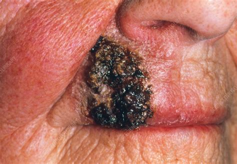 Squamous Cell Carcinoma On Lip After Radiotherapy Stock Image M131