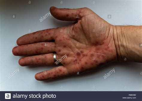 Hand Foot And Mouth Disease Hi Res Stock Photography And Images Alamy