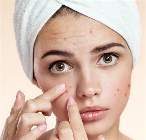 สิวอักเสบ (Inflammatory acne ) เจ็บสิว เรื่องสิวที่อาจจะเกิดปัญหาผิวที่ ...