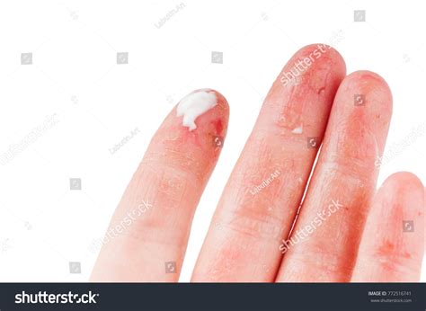 Womans Hand Wounds Eczema Dermatitis Stock Photo 772516741 Shutterstock